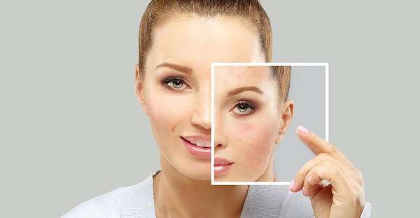 best beauty treatments with no downtime