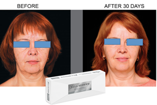 Redermalisation -before-and-after