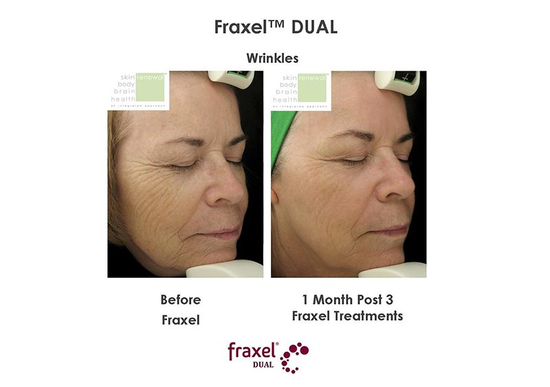 Fraxel vs Dermapen